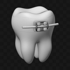Dente com Bracket - Modelo 3D