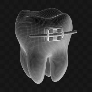 Dente com Bracket - Modelo 3D