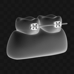 Molares Com Aparelho - Modelo 3D